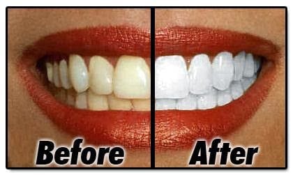 Dazzlin White Teeth Whitening of Rome