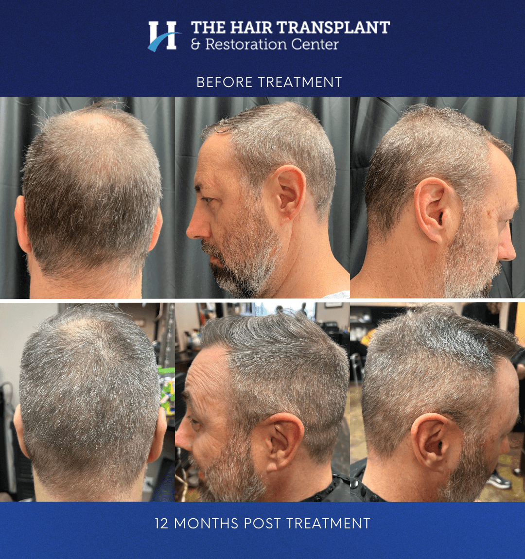 The Hair Transplant & Restoration Center