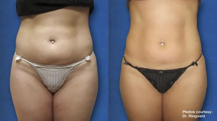 OC Laser Lipo @ Talega Day Spa, San Clemente, photo 3