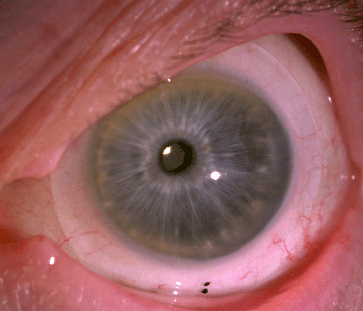 In Focus: Scleral & Specialty Contact Lens Solutions