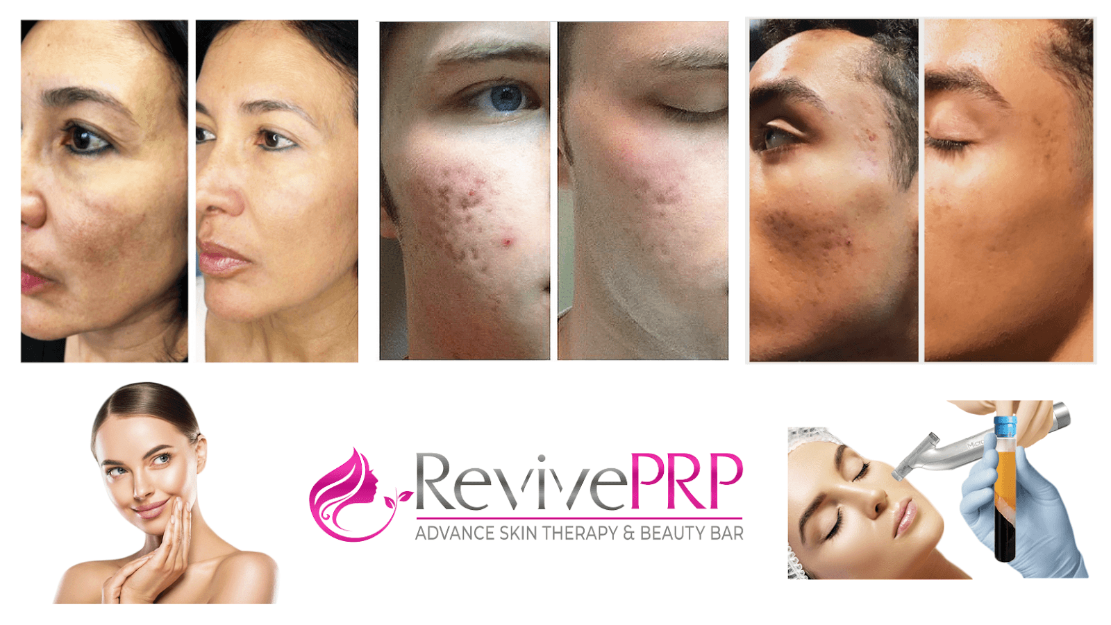 RevivePRP, photo 2