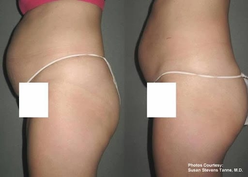 OC Laser Lipo @ Talega Day Spa, San Clemente, photo 2