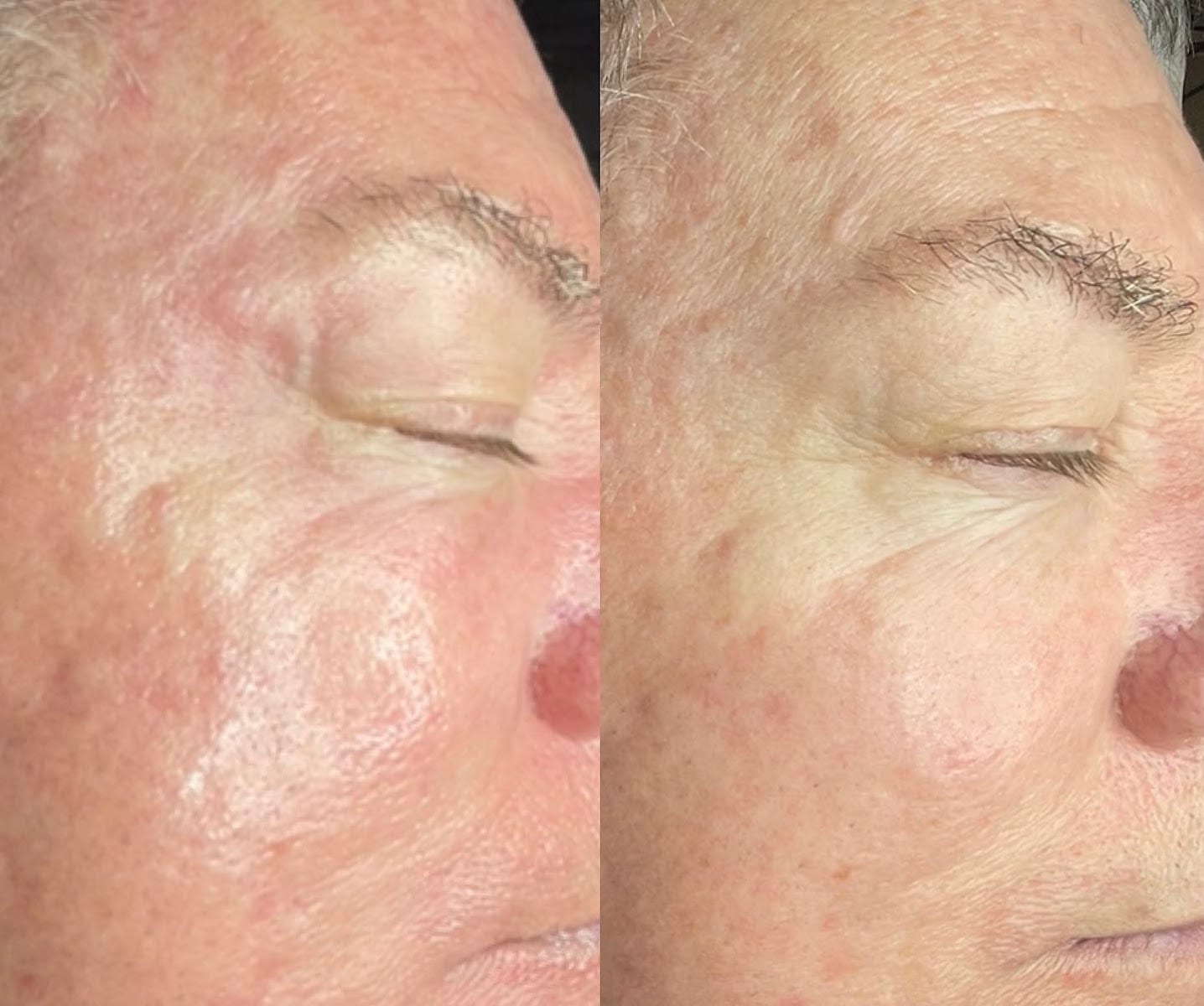 Hydrafacial and Chemical Peels by Kapri Skin