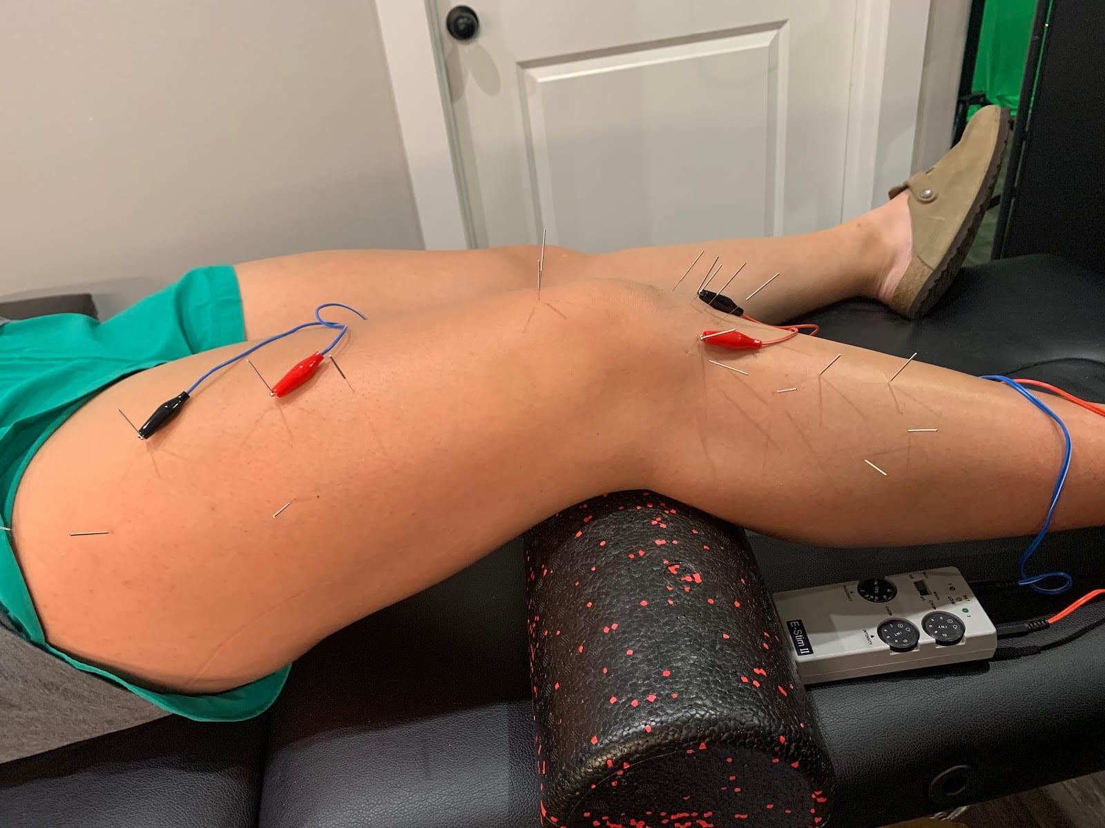 Tivis Dry Needling, photo 3