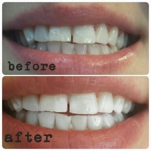 H-Smile Teeth Whitening and Dental Teeth Cleaning In Richmond Hill, photo 4