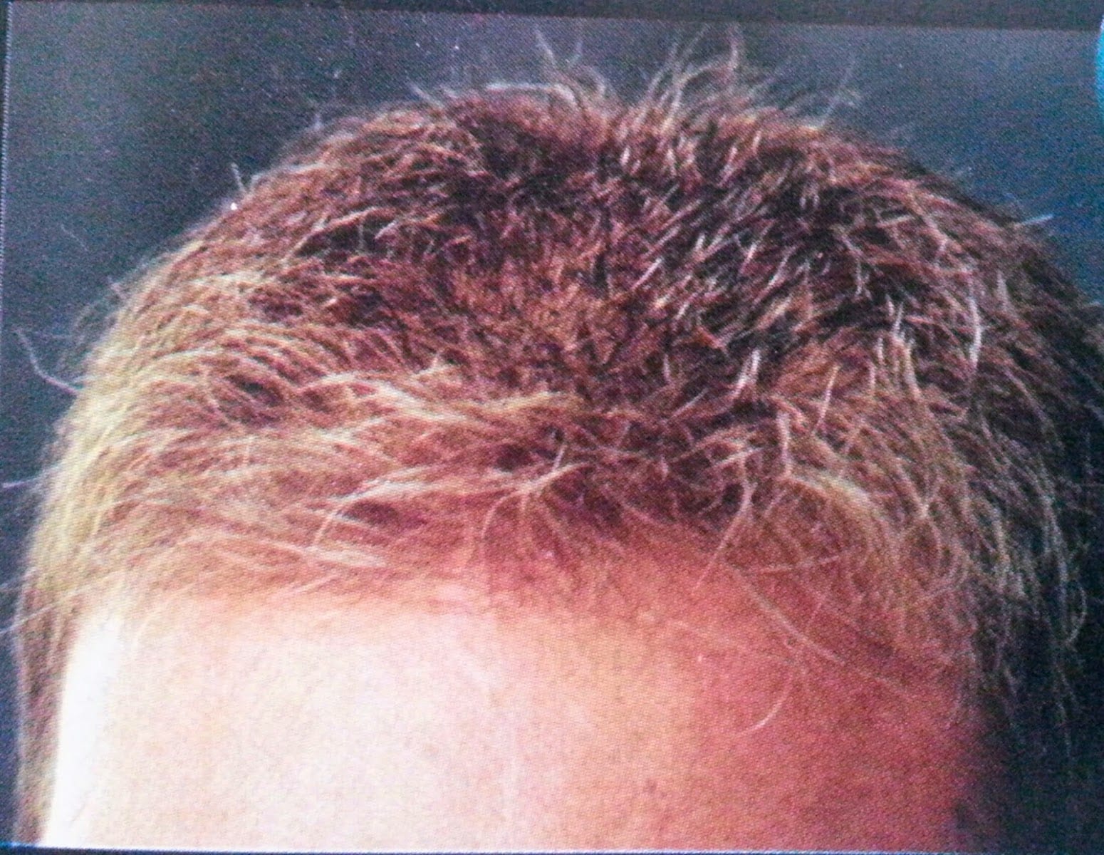 Southbridge Hair Replacement Center