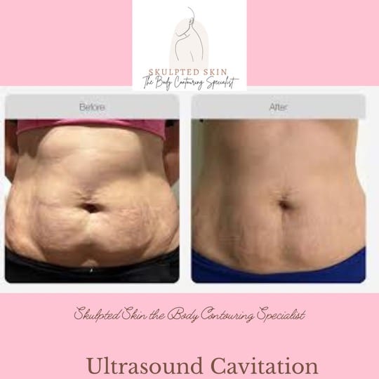 Skulpted Skin the Body Contouring Specialist