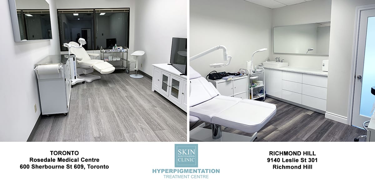 Hyperpigmentation Treatment Clinic Cosmelan Richmond Hill