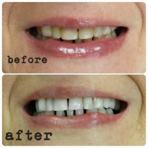 H-Smile Teeth Whitening and Dental Teeth Cleaning In Richmond Hill, photo 3