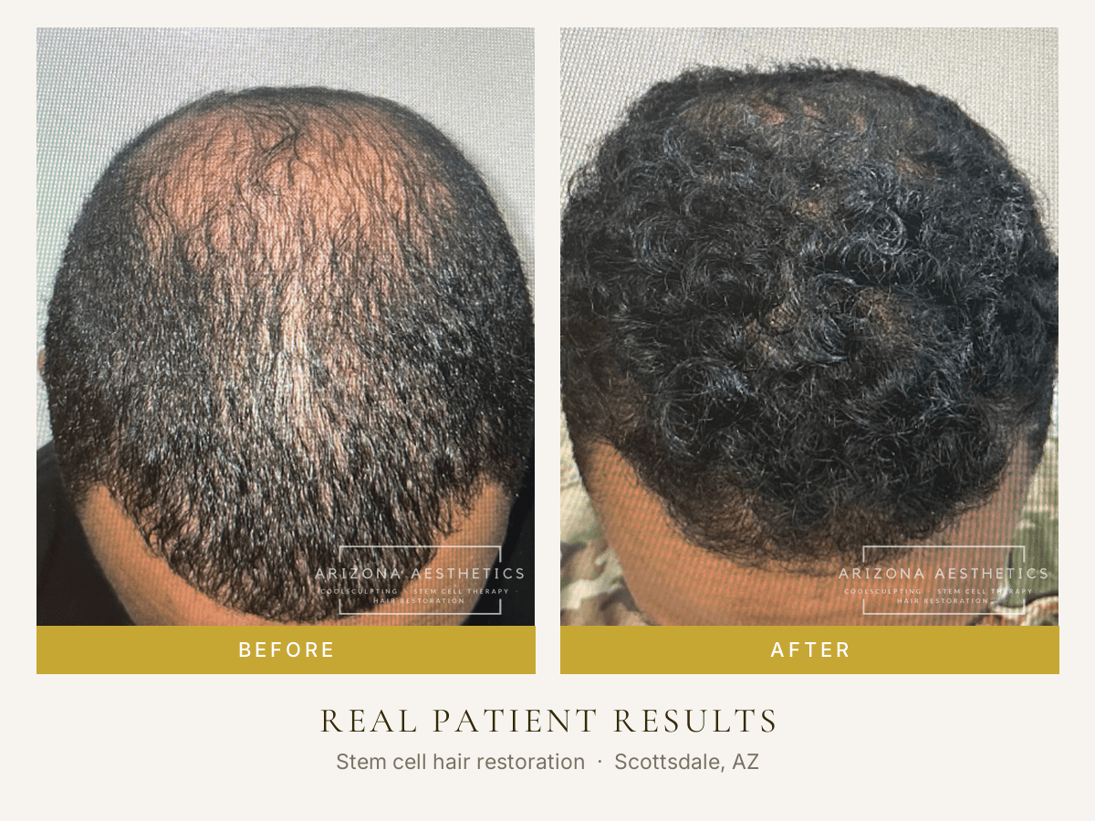 Arizona Aesthetics | Hair Restoration & Stem Cell Therapy