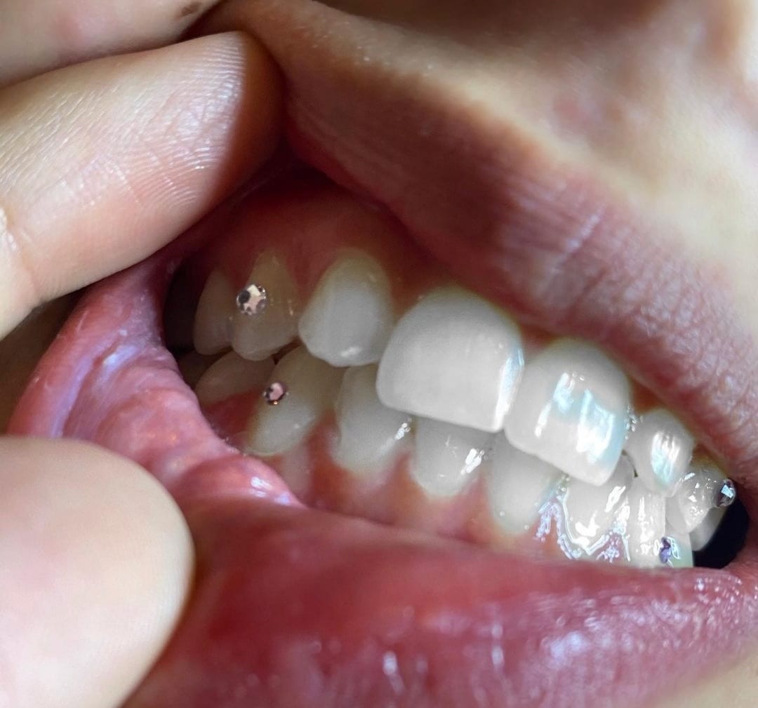 Hollywood Smiles409 Cosmetic Teeth Whitening, photo 4