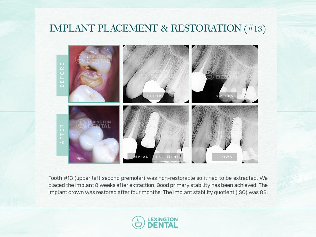 Lexington Dental Frisco