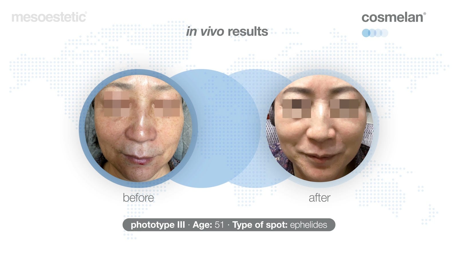 Hyperpigmentation Treatment Clinic Cosmelan Richmond Hill