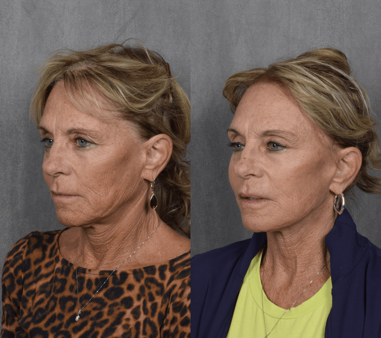 Vegas Facial Plastics - Mehdi Sina MD, MBA, photo 3