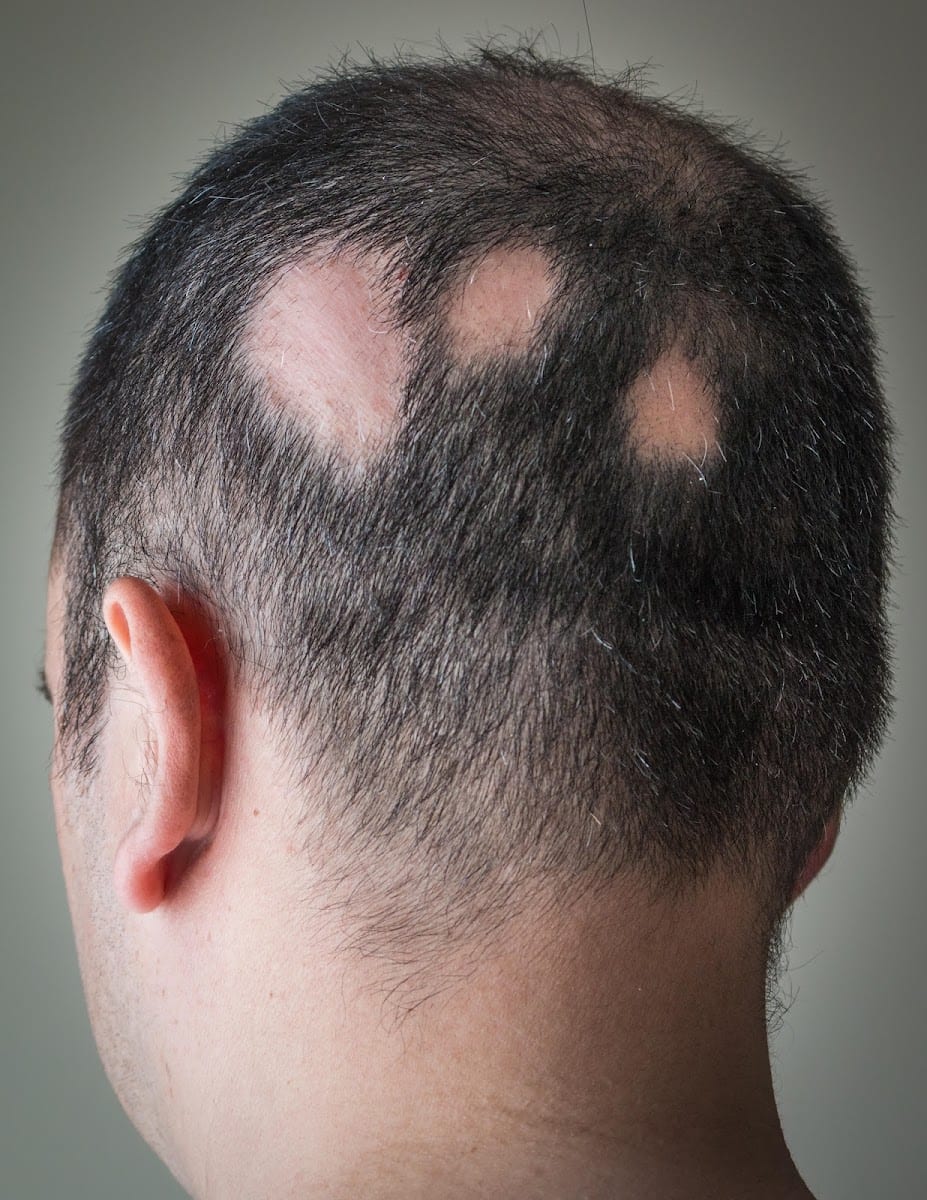 Laser hair growth treatment