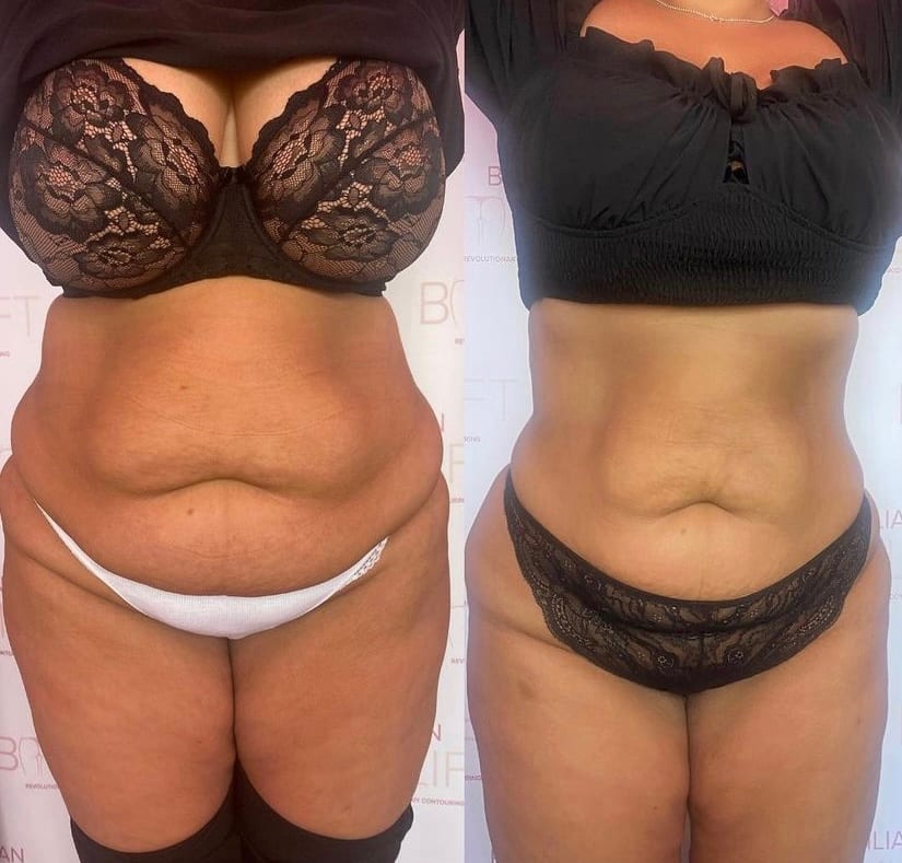 Body Sculpting Herts, photo 2