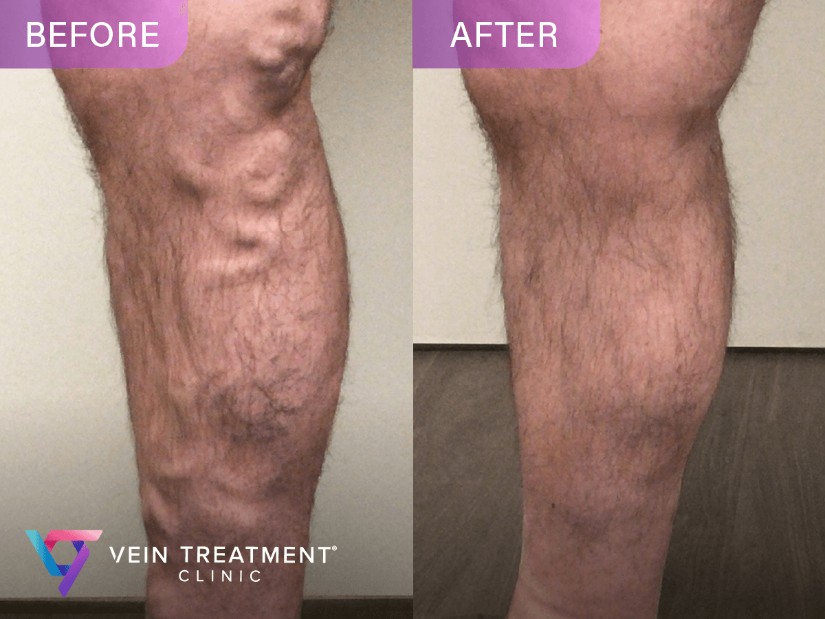 Vein Treatment Clinic | Paramus, NJ