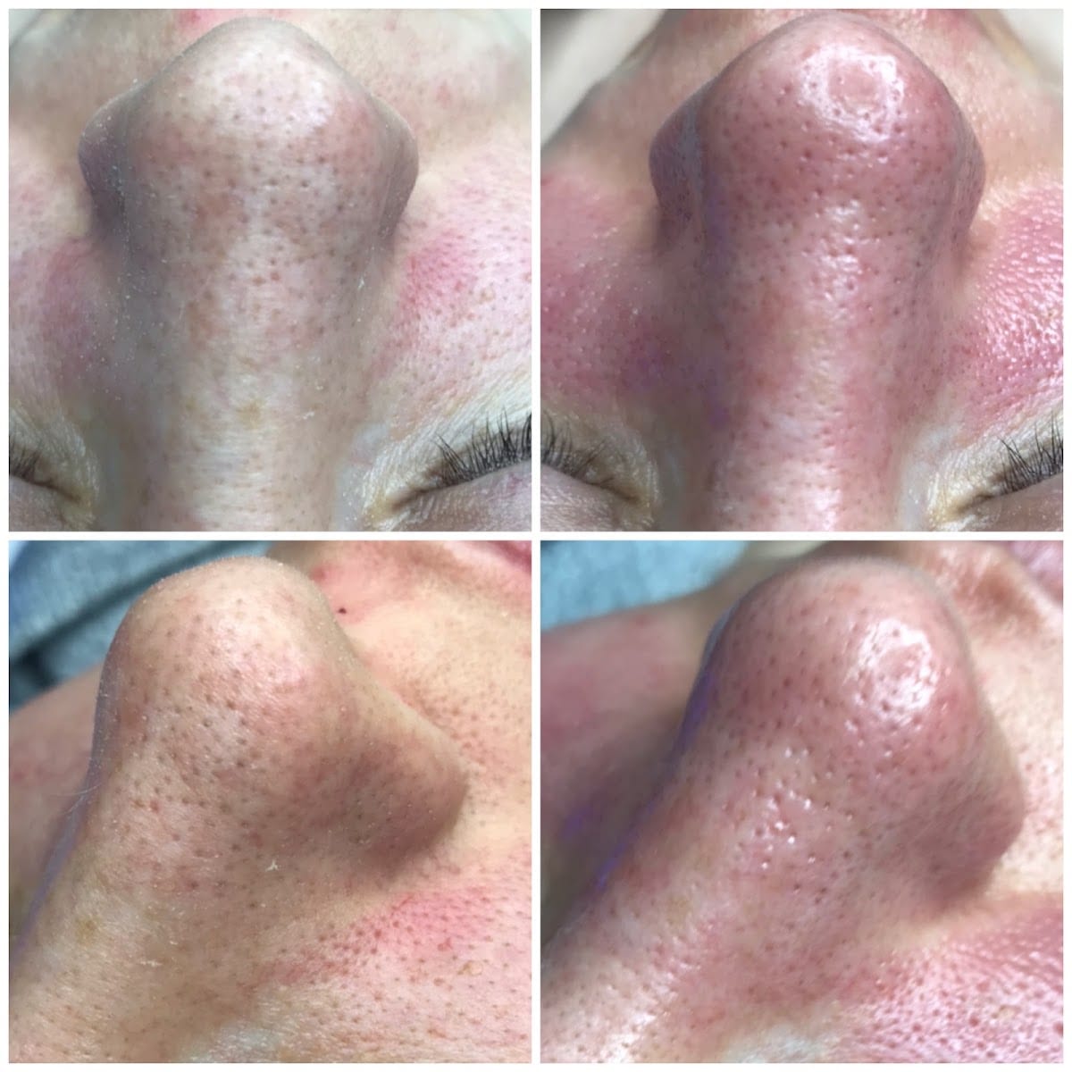 Hydrafacial and Chemical Peels by Kapri Skin, photo 2