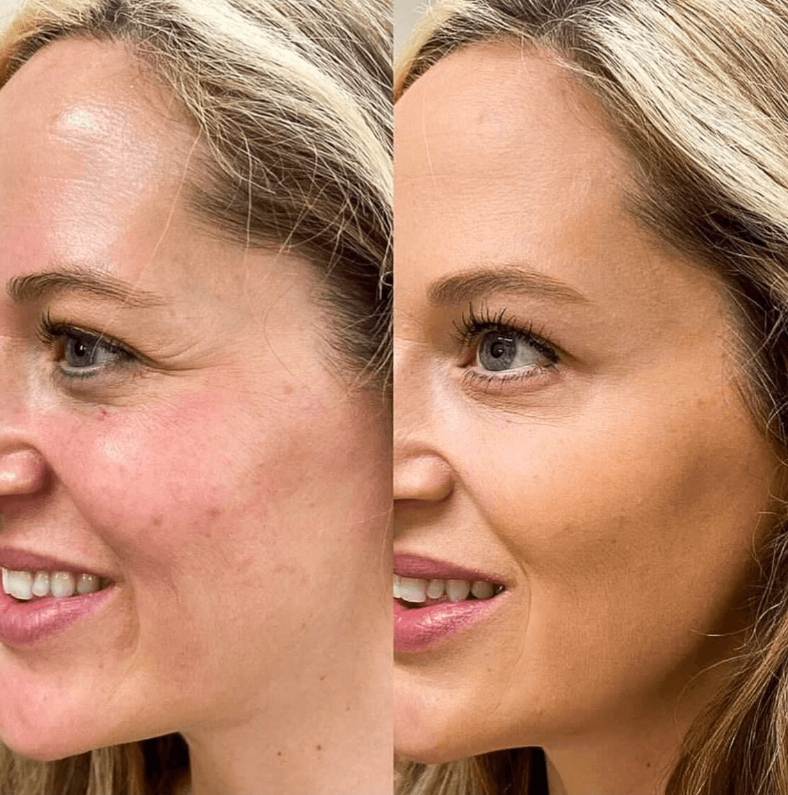 L. Britt Swor-Yim, M.D. | Facial Aesthetics | Botox, Filler, Y-Lift
