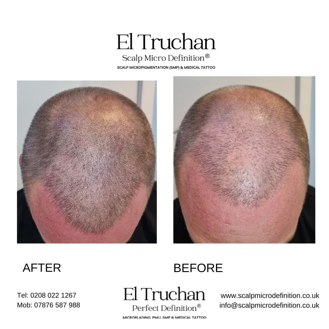 Perfect Definition Microblading, SMP, Permanent Makeup, Medical Tattoo by El Truchan @ CITY, photo 4