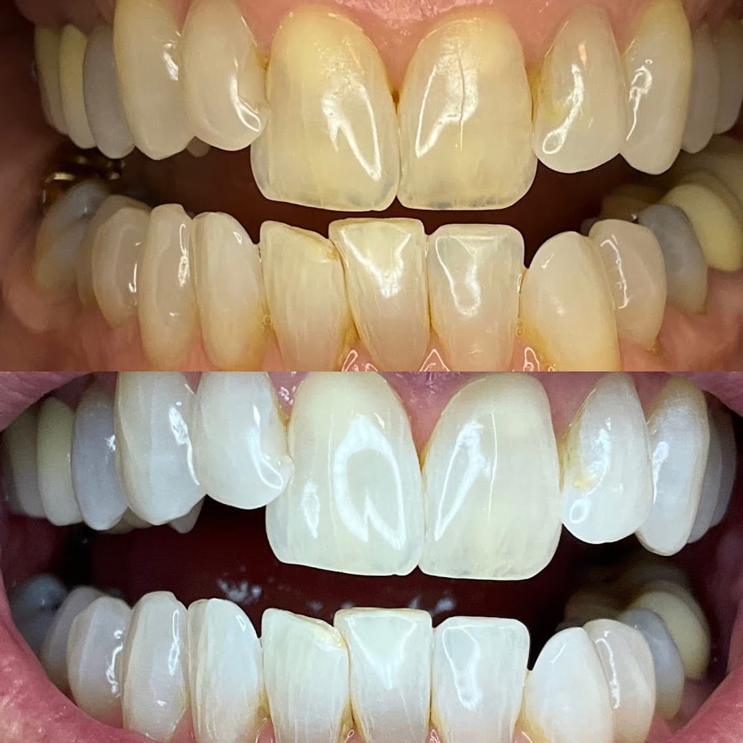 We Whiten Teeth Whitening, photo 2
