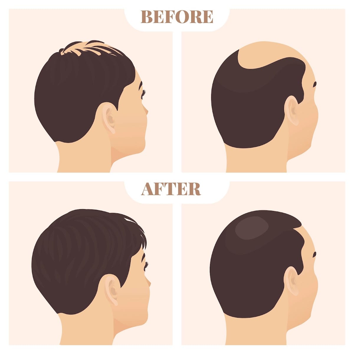 Laser hair growth treatment, photo 2