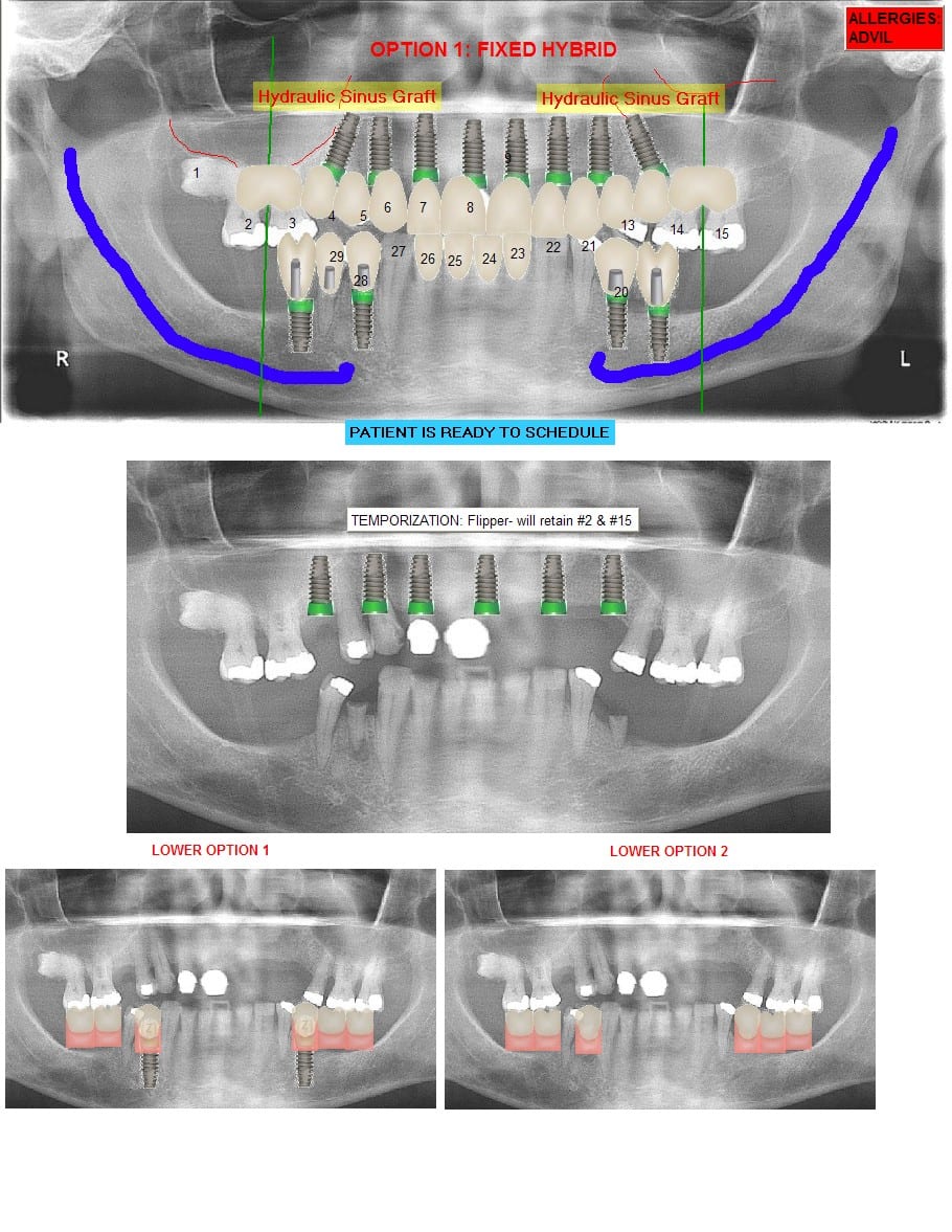 Sarasota Implant