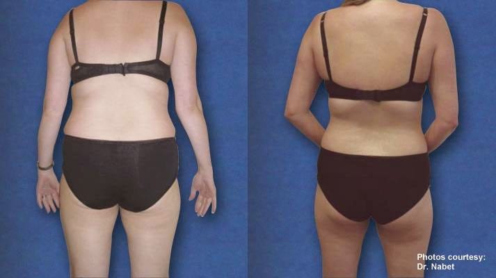 OC Laser Lipo @ Talega Day Spa, San Clemente
