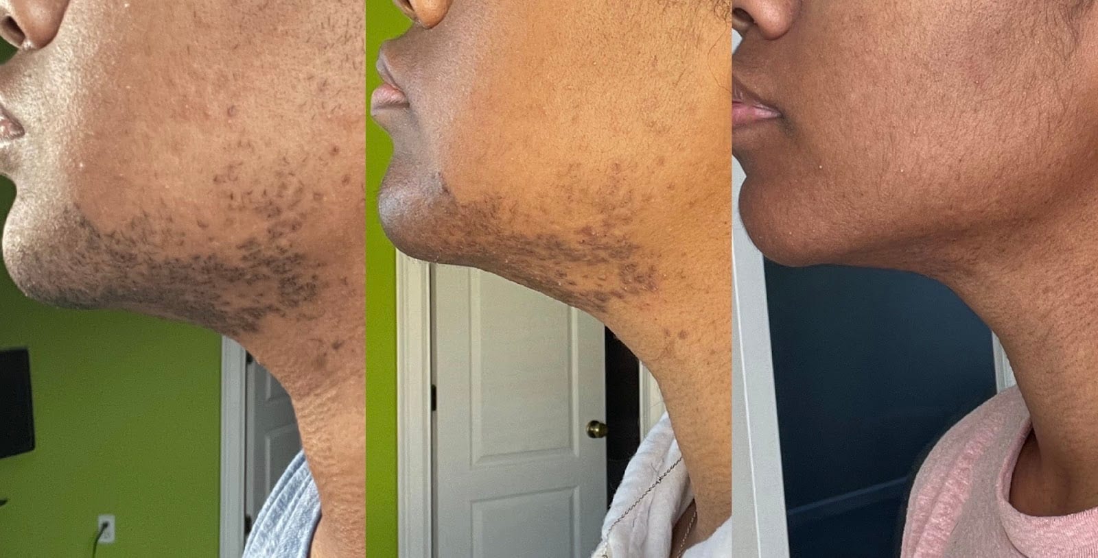Skin Deep Electrolysis, photo 2