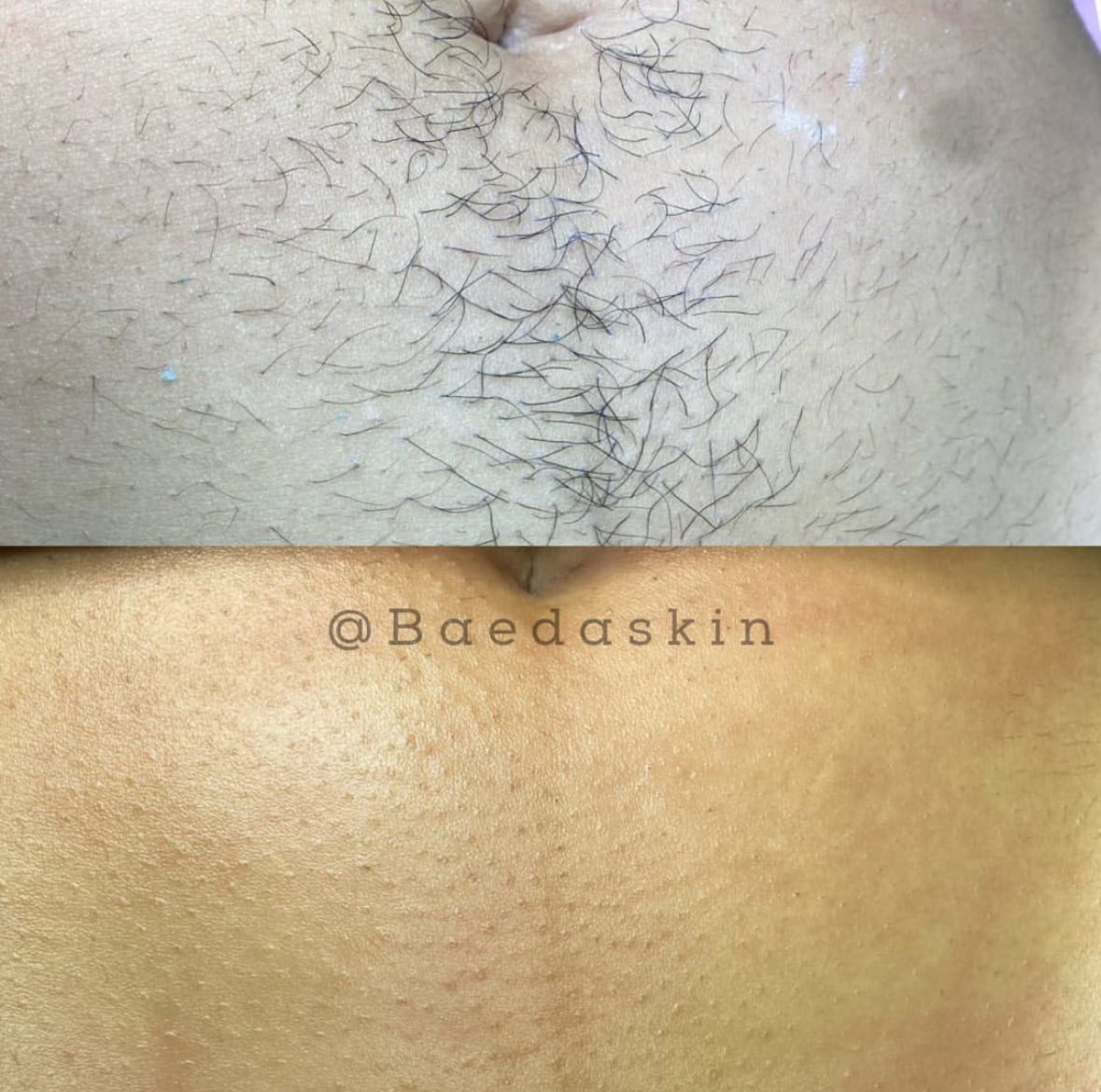 BaedaSkin Brazilian Waxing And Vajacials