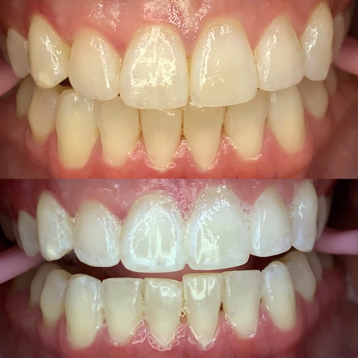 Xpress Whitening