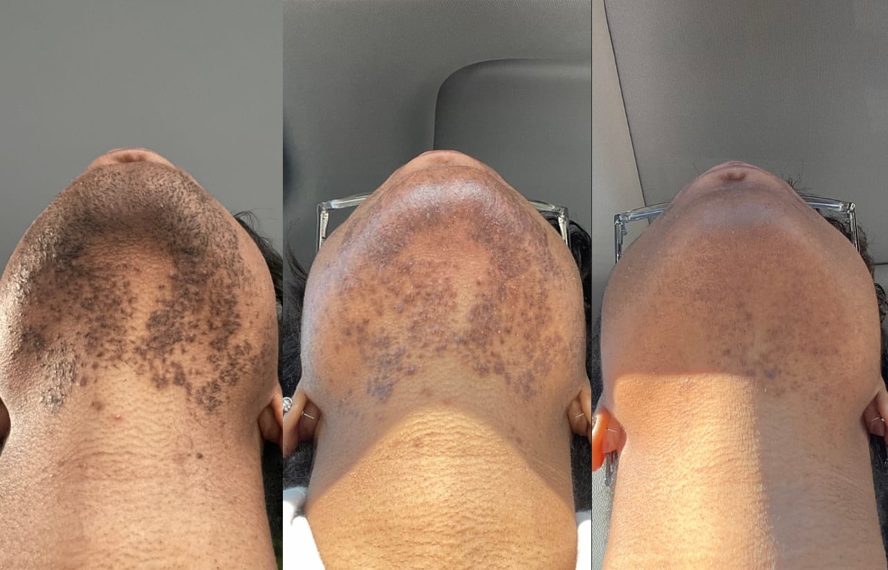 Skin Deep Electrolysis