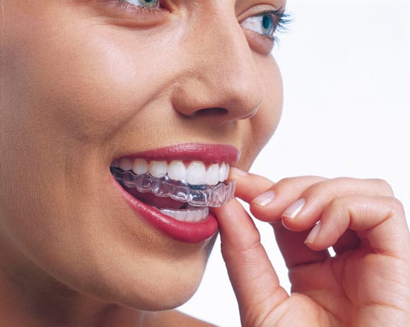 Invisalign St Albans