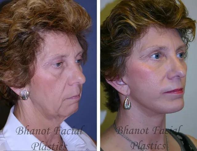 Bhanot Facial Plastic Surgery