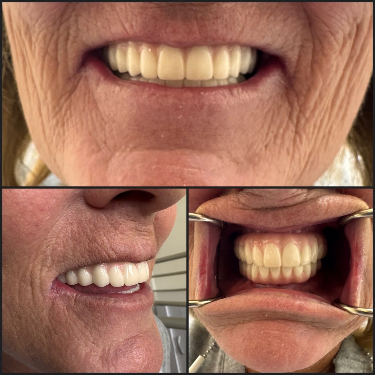 Crown Dental