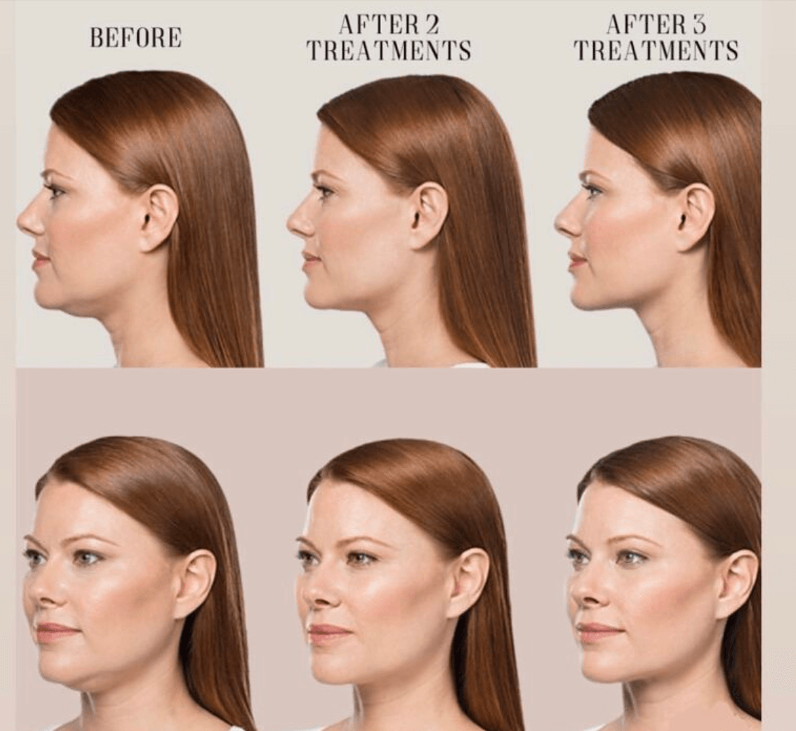 L. Britt Swor-Yim, M.D. | Facial Aesthetics | Botox, Filler, Y-Lift, photo 2