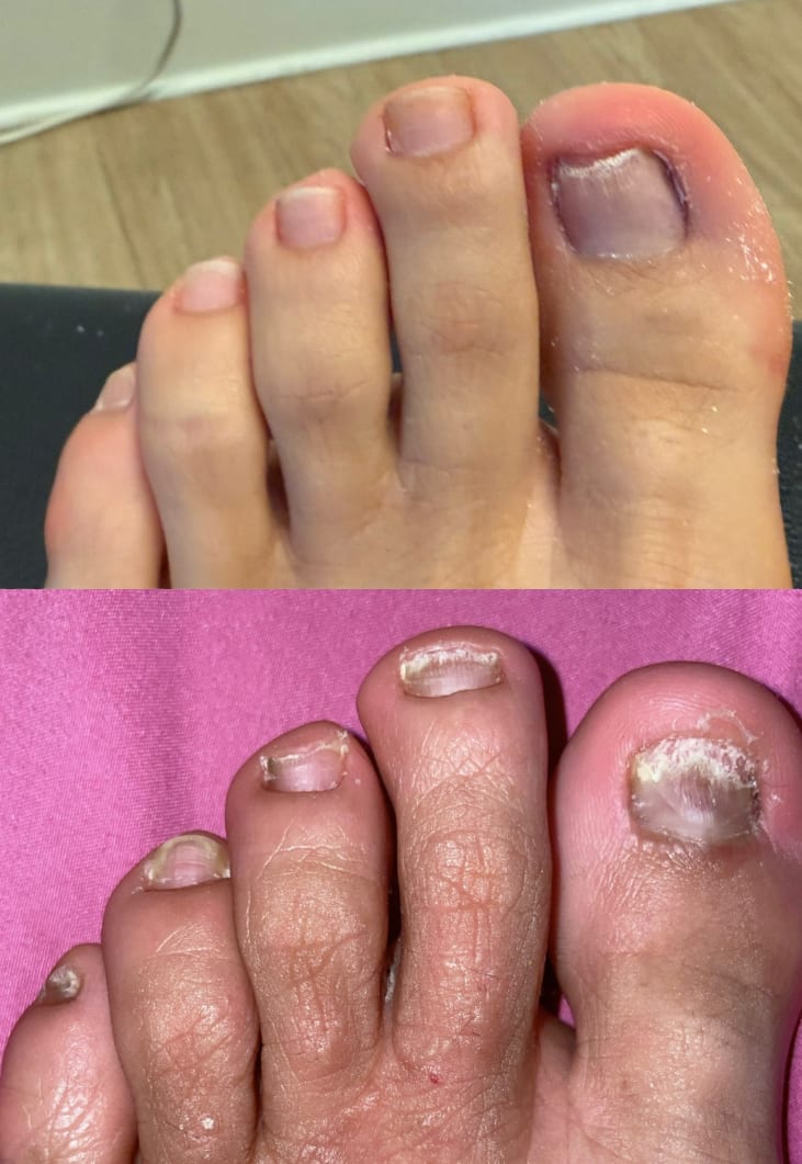 Bay Area Fungal Nail Clinic