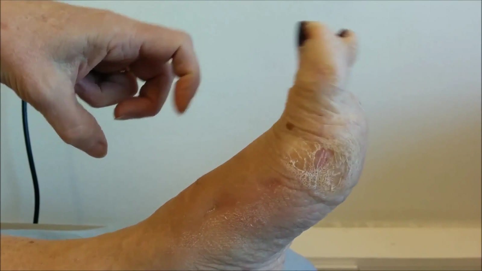 Mr David Gordon - Consultant Orthopaedic Foot and Ankle Surgeon & Keyhole Bunion Specialist, photo 4