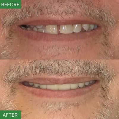 NJ Implant Dentist | All-on-4 & Full Arch Expert, photo 3