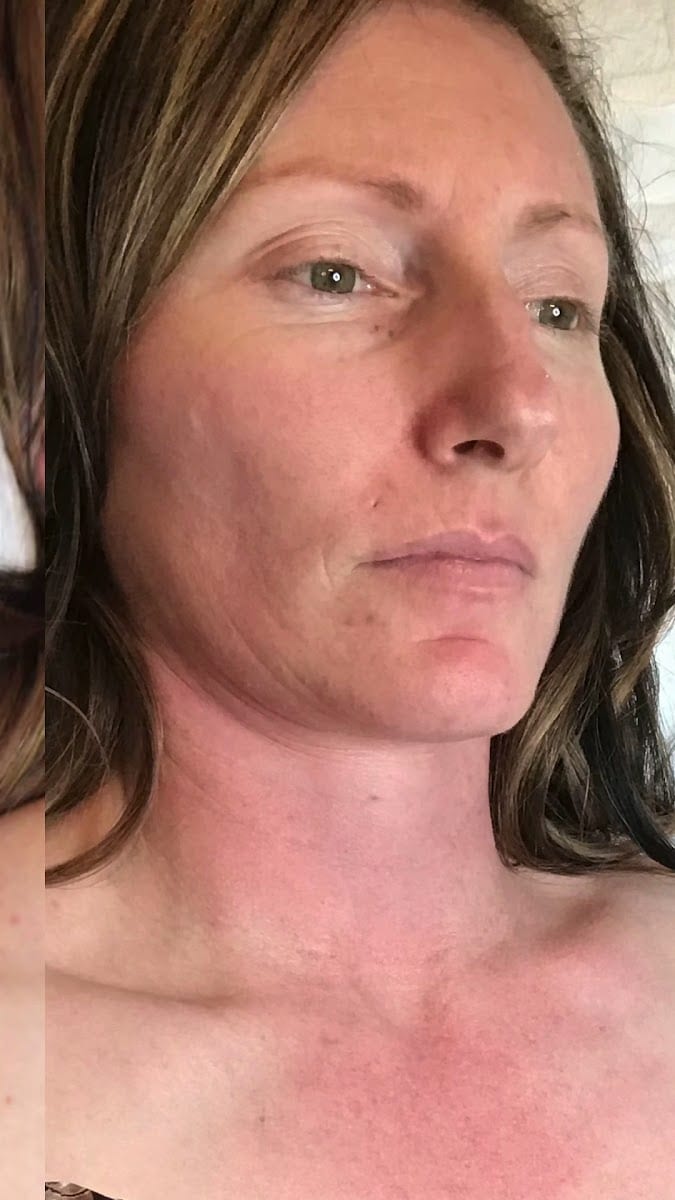 Hydrafacial and Chemical Peels by Kapri Skin, photo 3