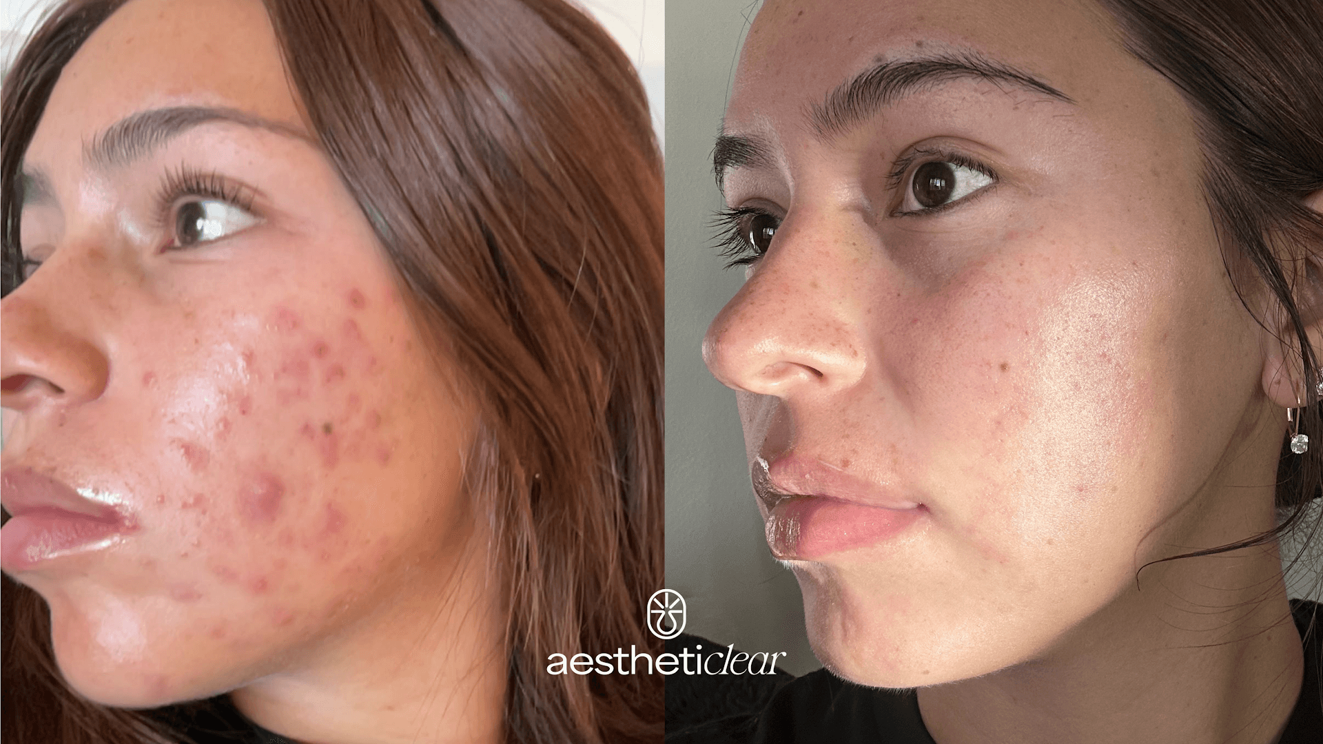 Aestheticlear Acne Clinic | Centennial, CO