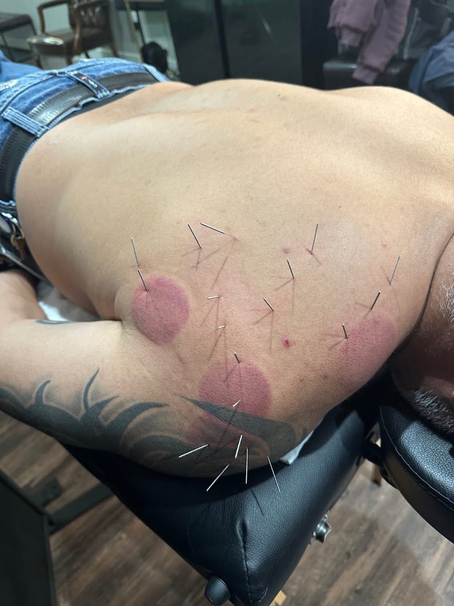 Tivis Dry Needling, photo 4