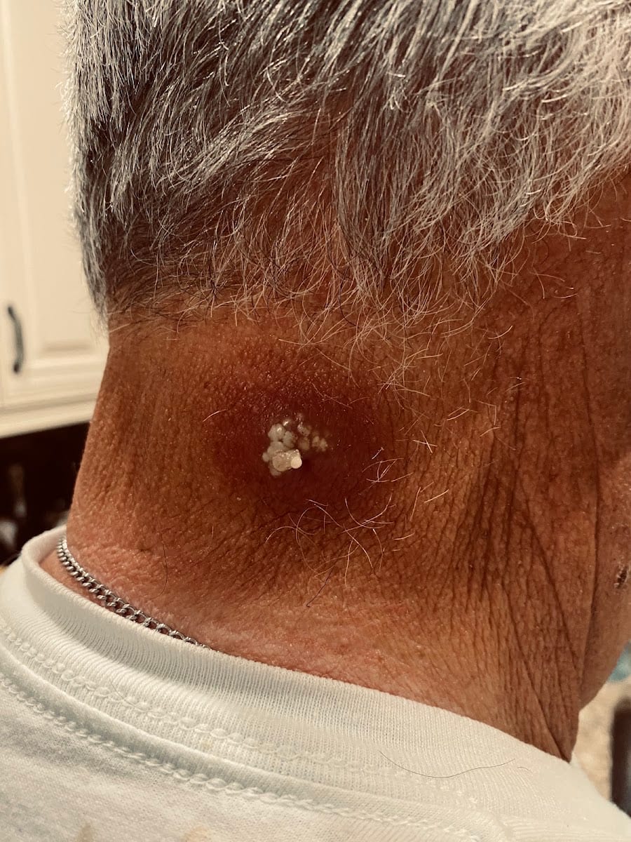 Jeffrey R. Hunek, M.D., Venice Avenue Dermatology