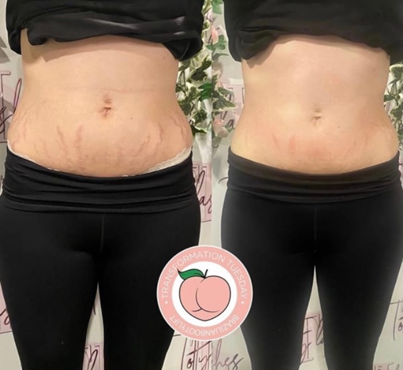 Body Sculpting Herts, photo 3