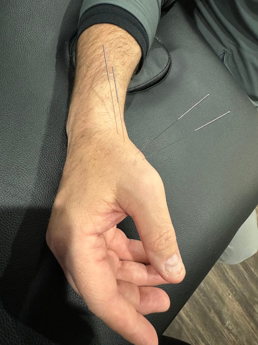 Tivis Dry Needling