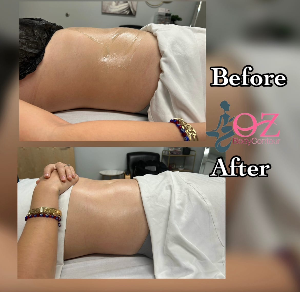 Oz body contour