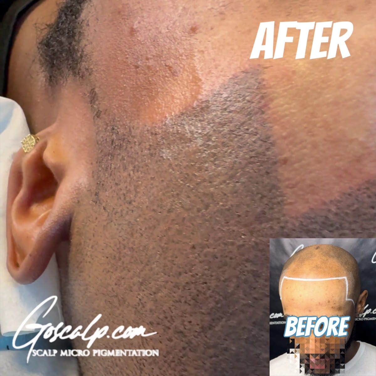 Goscalp Scalp Micropigmentation Hair Loss Center, photo 4