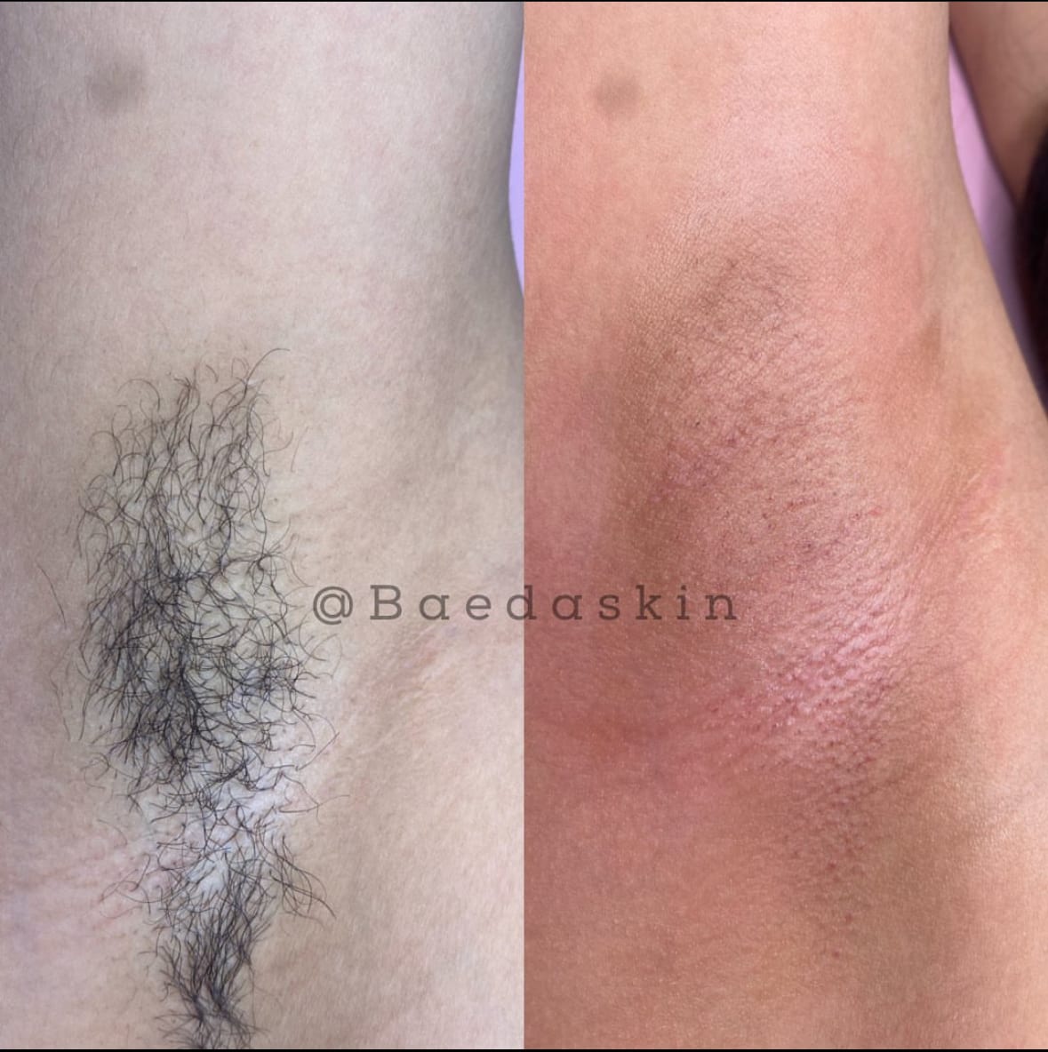 BaedaSkin Brazilian Waxing And Vajacials, photo 2
