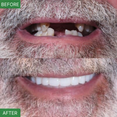 NJ Implant Dentist | All-on-4 & Full Arch Expert, photo 4