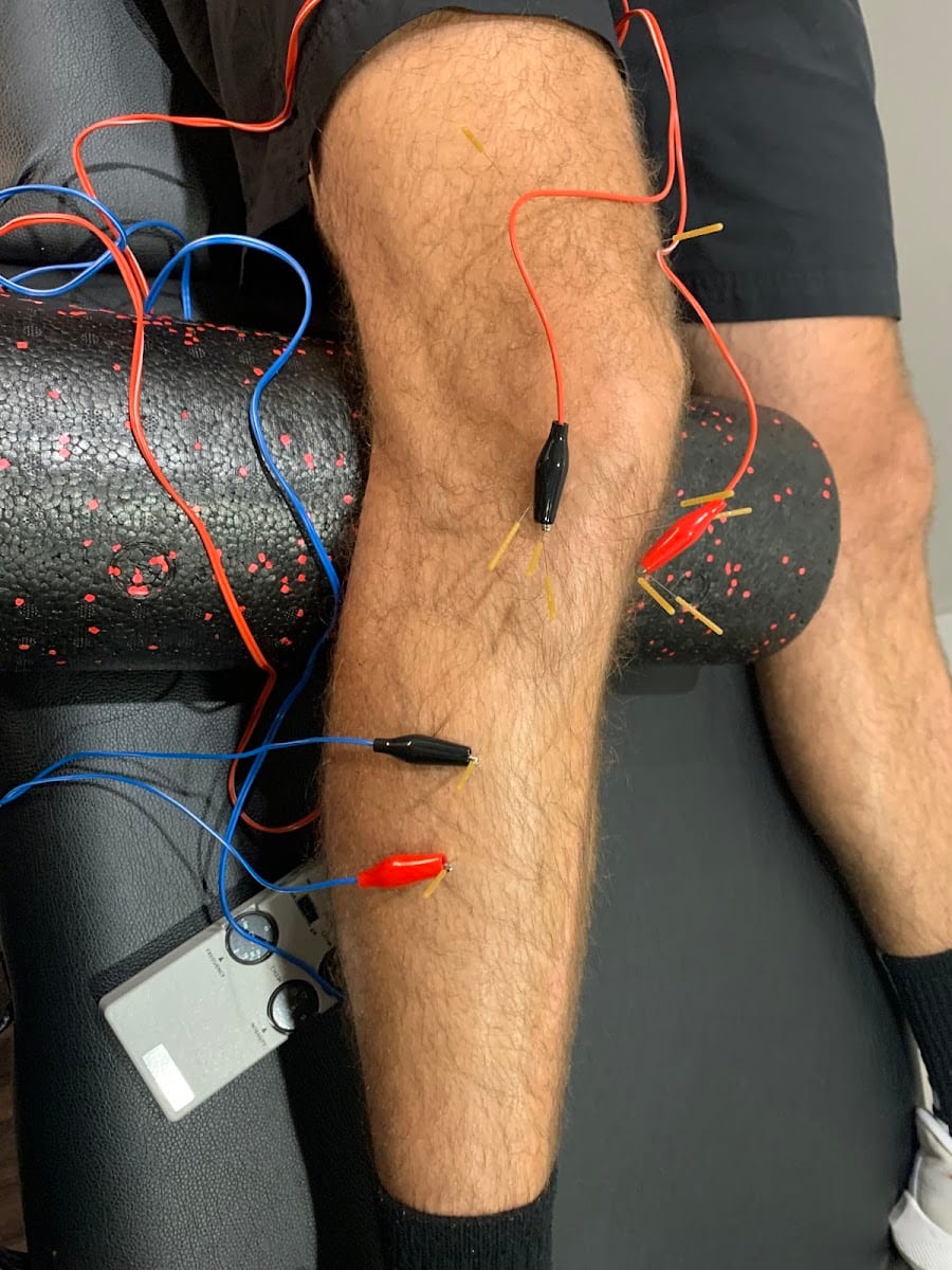 Tivis Dry Needling, photo 2